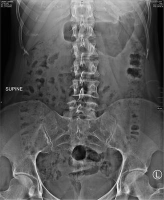 femoral scoliosis