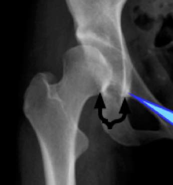 Notice sloping acetabulum and unroofed hip. 