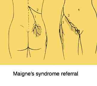 Maigne's syndrome referral pattern.