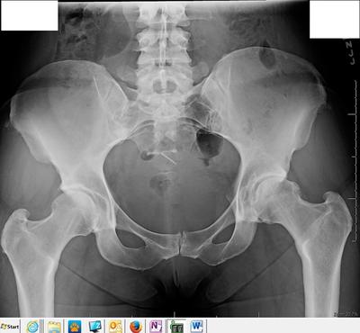 Hip xrays 6 weeks apart different facilities