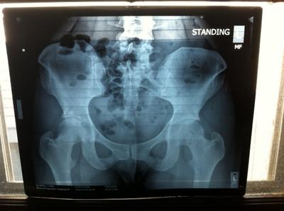 Pelvic XRay Standing