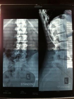 Side and Spinal XRay Standing