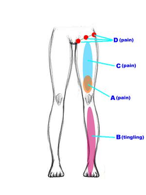 Left Front Thigh Pain