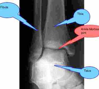 X-ray of joints in the ankle