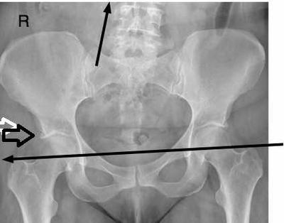 Often there are pre existing conditions in the hip too. 