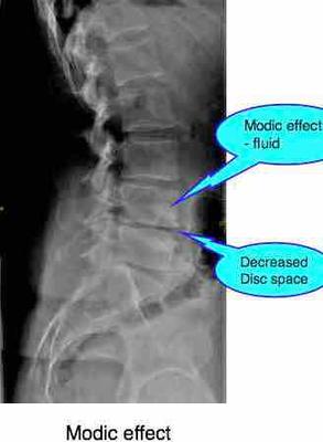 lower back, outer hip and leg pain.