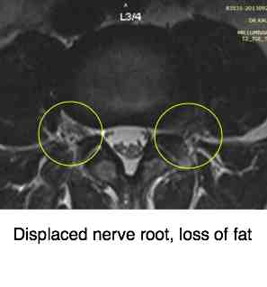 Displaced fat in the foramen points to a large disc prolapse. 