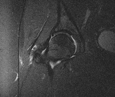 query labral tear?