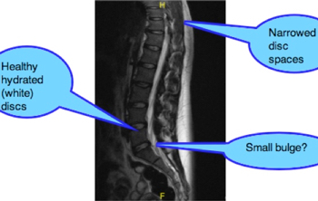 Maigne's syndrome on X-ray.