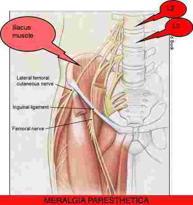 meralgia paresthetica pillow