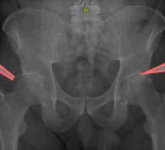 X-ray showing mixed FAIS. X-ray showing mixed FAIS.
