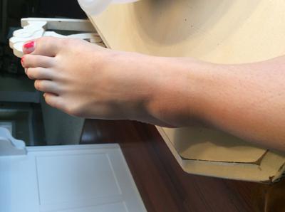 This is what my ankle looks like now.