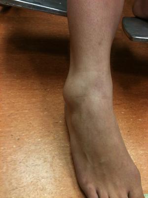 Multiple ankle sprains