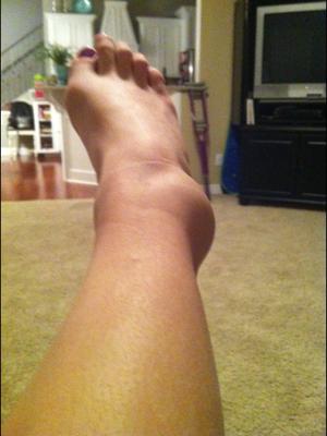 One of my worst ankle sprains 
