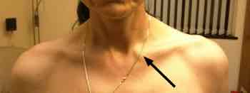 Is it swollen and tender at the arrowhead?