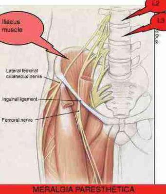 Meralgia paresthetica causes upper lateral leg pain and numbness.