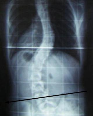 A more serious scoliosis caused by a very short leg. 