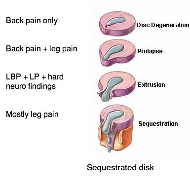 gabapentin for back disc pain