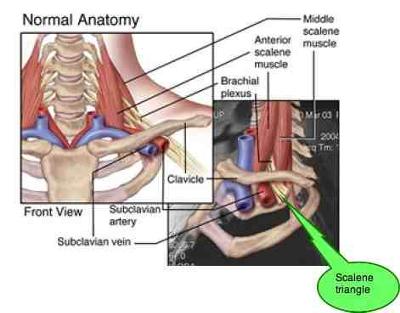 Thoracic Outlet Syndrome