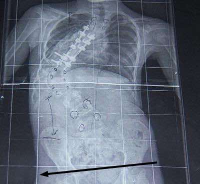 This is a bad scoliosis; unlikely yours is anything like this. 