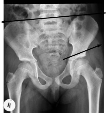 An x-ray will usually reveal what's happening in your hip