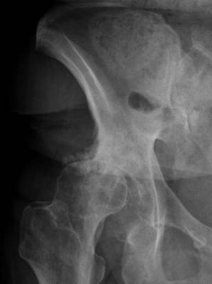 What's happening in your hip?