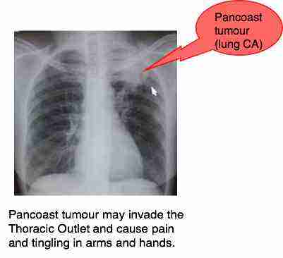 Cervical ribs are an uncommon anomaly causing pain tingling in arms and