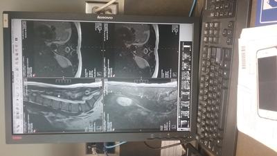 Pic of MRI of low back in October