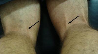 Have the quadriceps and medial hamstrings reflexes been tested?