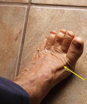 Can you extend the great toe?