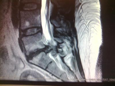 Residual Pain After Healed Disk Herniation L5 S1