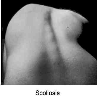 Scoliosis