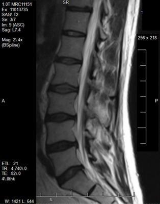 right leg shorter, lower back pain causing tension in back ...