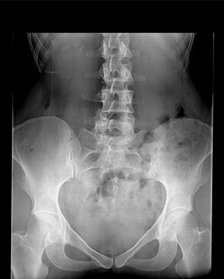 AP radiograph taken standing with 9mm heel insert on right side. Right side is on the right.