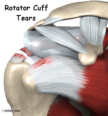 Shoulder anatomy is actually four joints wrapped up in one arm.