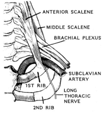 Thoracic outlet syndrome