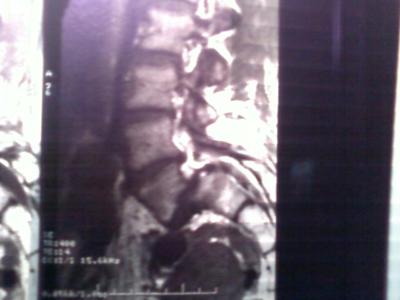 Grade III spondylolysthesis