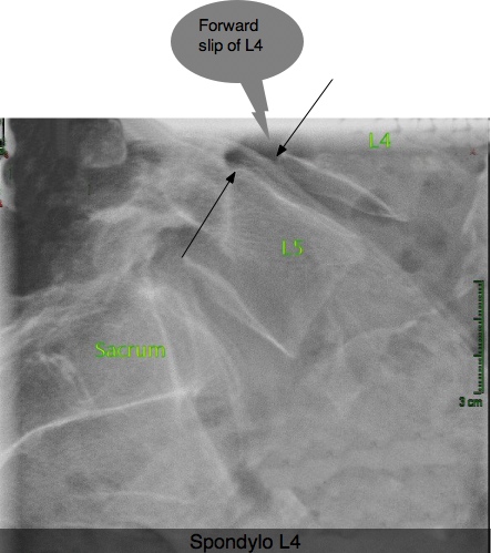 X-ray showing a spondylolysthesis of L4. X-ray showing a spondylolysthesis of L4.