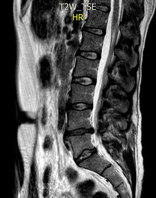 herniated stenosis disk l5 l4