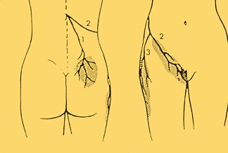 Maignes syndrome radiation.
