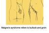 Maignes syndrome referral pattern