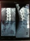 Side and Spinal XRay Standing