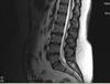 lumbar spine with L5 - pars defect