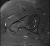 query labral tear?