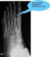 No signs of Freiberg's disease in John's foot
