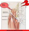 Lateral Femoral cutaneous nerve