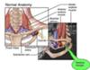Thoracic Outlet Syndrome
