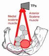 Thoracic outlet syndrome