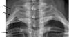 cervical rib