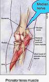Pronator teres affecting median nerve